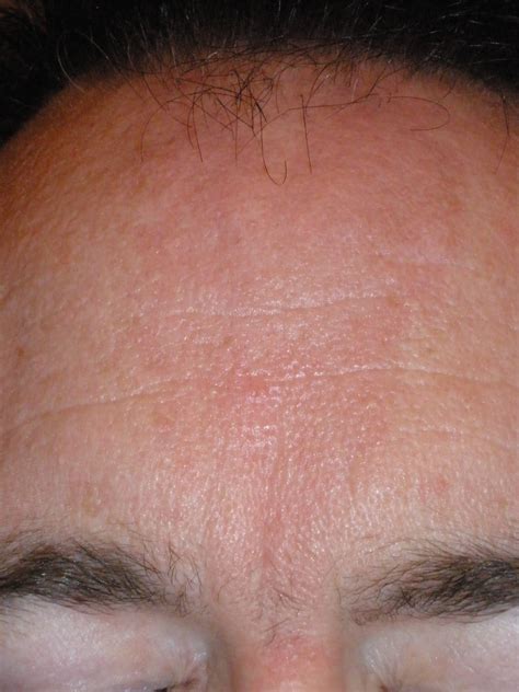 I Have Redness On My Forehead From A Minor Burn Over A Year