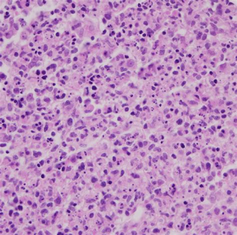 Histopathology Of The Affected Lymph Node Of The Patient Necrosis And