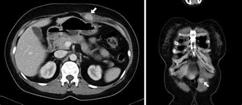 Ct Scans Of The Abdomen Without And With Iv Contrast Enhancement Are