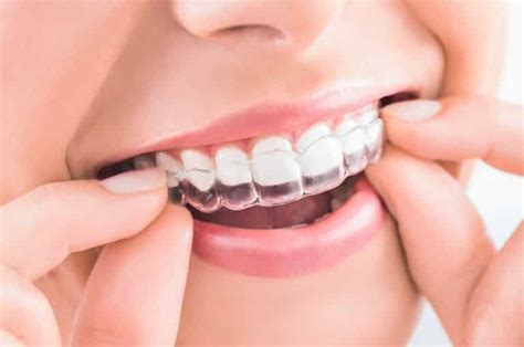 ¿Brackets u ortodoncia invisalign? ¿cuál elegir en madrid?