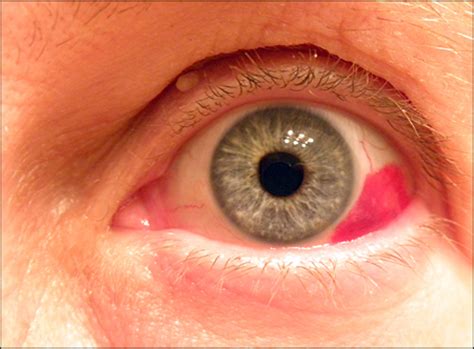 Red spots on the eye are called subconjuctival hemorrhage, which can be simply defined as bleeding in the eye. Painless Red Eye - Photo Quiz - American Family Physician