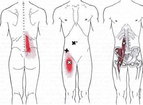 Myofascial Trigger Point Therapy