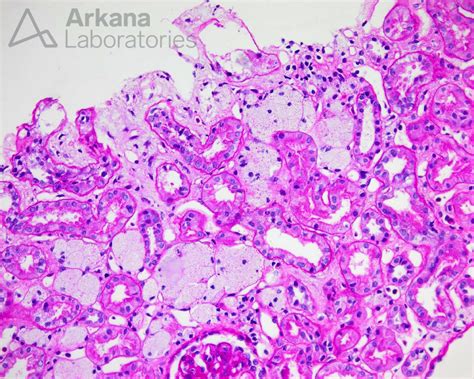 Alport Syndrome Diagnose This Arkana Laboratories