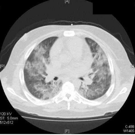 Chest Ct Scan Shows Diffuse Bilateral Patchy Opacities Arrows Ct