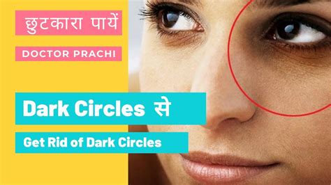 Dark Circles Causes Remedies And Treatment How To Get Rid Of Dark