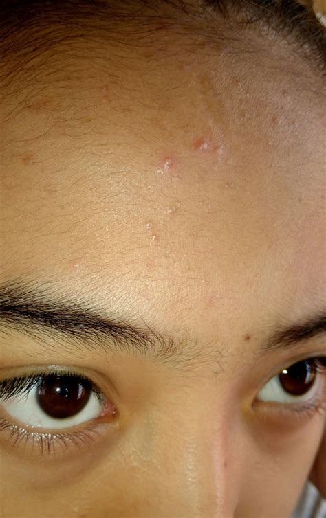 Pimples All Over My Forehead General Acne Discussion By Angeltrev