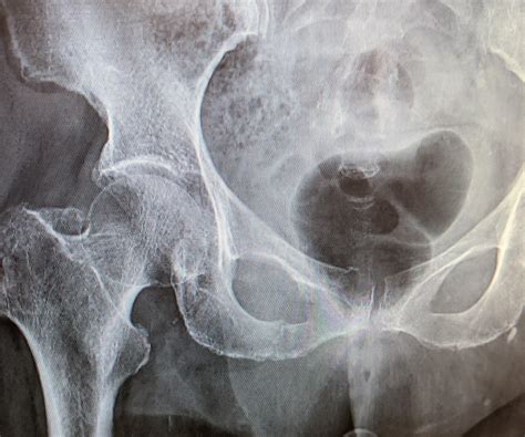 Saw this pubic ramus fracture at my internship. Is there ...