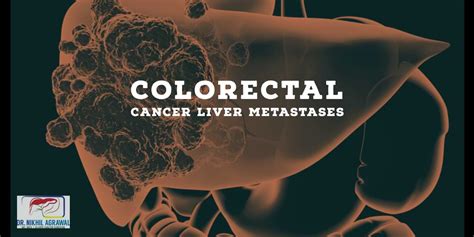 Colorectal Cancer Liver Metastases Treatment And Surgery Dr Nikhil