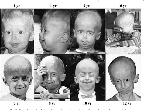 Pdf Hutchinson Gilford Progeria Syndrome Review Of The Phenotype