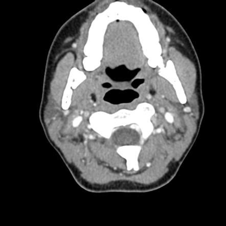 Ct Scan Of Head And Neck Showing Parathyroid Cystic Mass Extending Into My Xxx Hot Girl