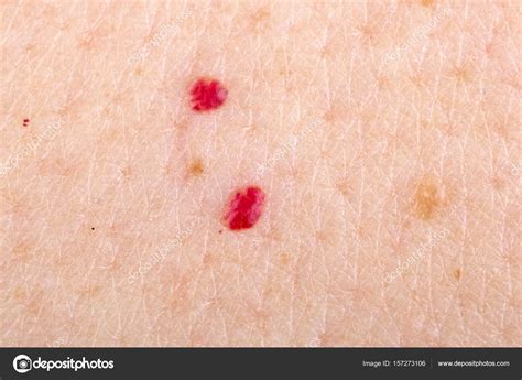 Cherry Angioma On Human Skin Stock Photo By ©obencem 157273106