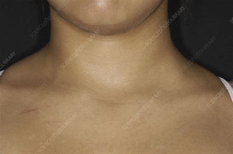 Swelling Due To Cervical Rib Stock Image M3500370 Science Photo