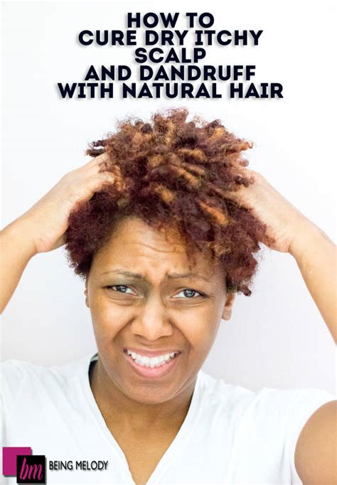 How To Cure Dry Itchy Scalp And Dandruff With Natural Hair