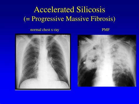 Ppt Silicosis Medical Aspects Powerpoint Presentation Free Download