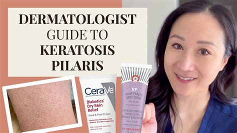 Dermatologist Guide To Kp Keratosis Pilaris Chicken Skin Youtube