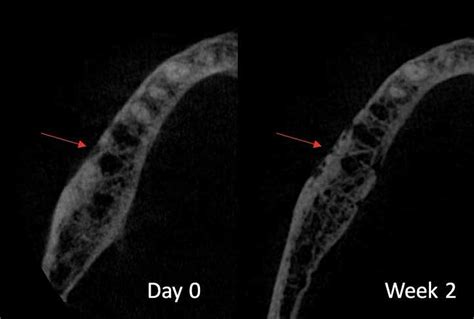 Diagnostic Difficulty Of A Mandibular Manifestation Of Diffuse Large B