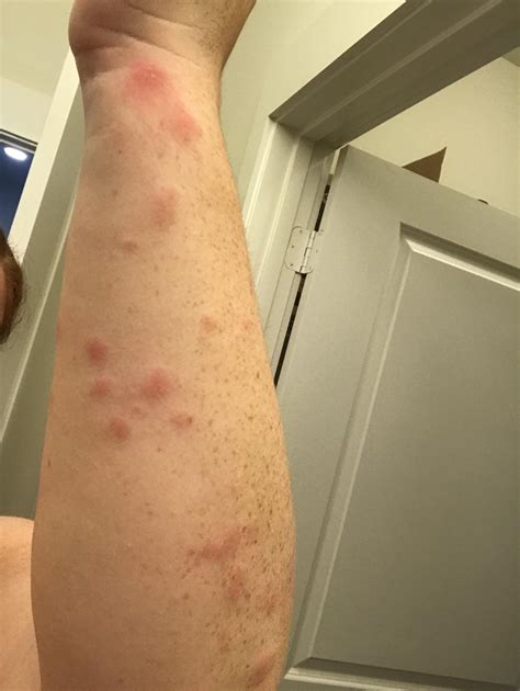What Do Bed Bug Bites Look Like What Do Bed Bug Bites Look Like Bed Images And Photos Finder