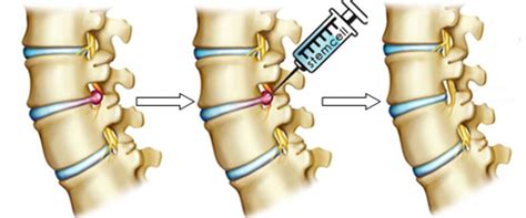Depending on the level of disc injury, you may require surgery or just undergo back pain treatment. Lumbar Disc Herniation Treatment - Diagnoses - Beijing Puhua International Hospital