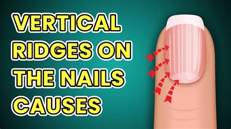 Do You Have Vertical Ridges On Your Nails Causes And Treatment Youtube