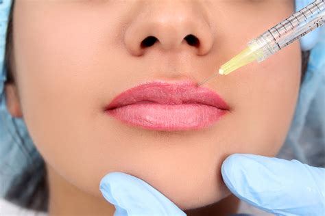 The Perfect Pout How To Use Lip Fillers Dentistry Co Uk