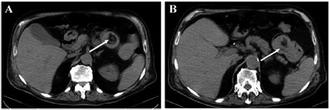 A Axial Enhanced Ct Scan Of The Abdomen Illustrating A Jejunal
