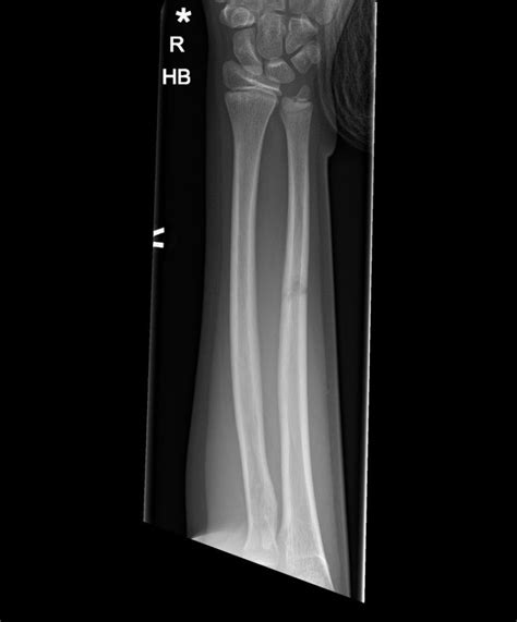 Midshaft Radius And Ulna Fractures