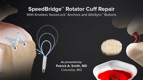 Speedbridge Rotator Cuff Repair With Knotless Swivelock Anchors And