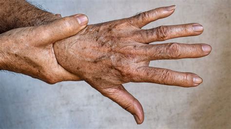 Ways To Get Rid Of Age Spots On Your Hands Say Dermatologists Lupon
