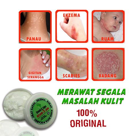 Kudis buta ataupun lebih dikenali sebagai scabies, merupakan sejenis penyakit kulityang mudah berjangkit. Ubat Hilangkan Kudis Buta - Agustus 2018