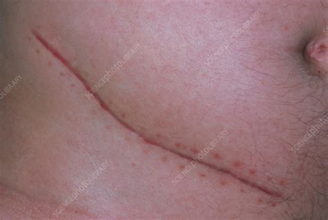 Appendicectomy Scar Stock Image M Science Photo Library