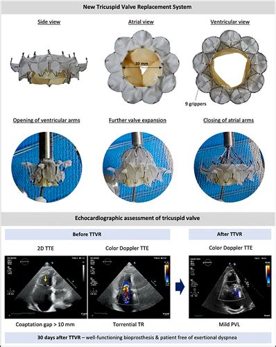First In Human Implantation Of A New Transcatheter Tricuspid Valve