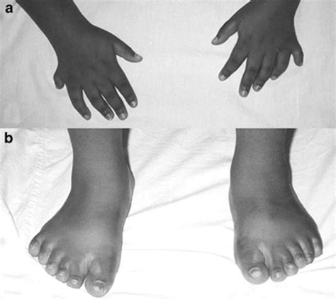 Human Polydactyly Is A Condition Of Extra Digits On Hands Or Feet Learn Science At Scitable