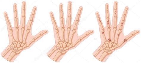Human Hands With Bone Fracture — Stock Vector © Interactimages 116840630