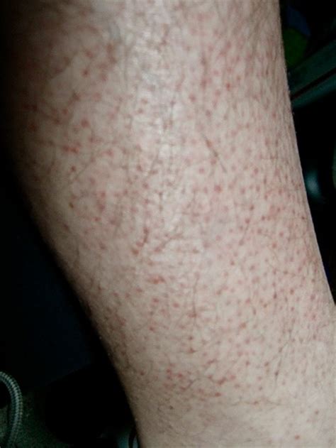 Red Dots On Legs Strawberry Legs How To Get Rid Of The Red Dots On