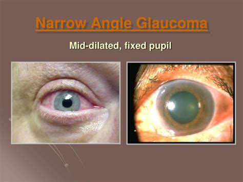 Glaucoma Angle Grading Astigmatism Glaucoma Swollen Eyes Disease My