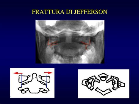 PPT - PATOLOGIA TRAUMATICA DELLA COLONNA VERTEBRALE ...