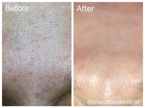 Sebaceous Hyperplasia — Sharon Gordon Skin