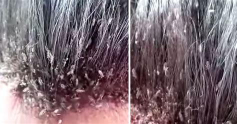 This Could Be The Most Extreme Head Lice Infestation And It Will Make