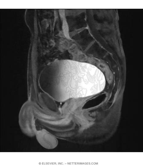 Median T1 Weighted Mri With Contrast Of Male Pelvis With A Full Bladder