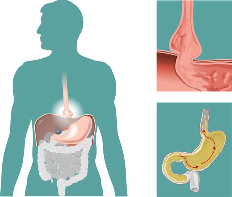 How To Repair A Hiatal Hernia Amberstevens