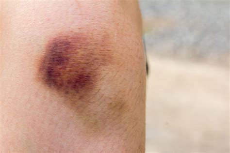 Best Bruised Knee Stock Photos Pictures And Royalty Free Images Istock