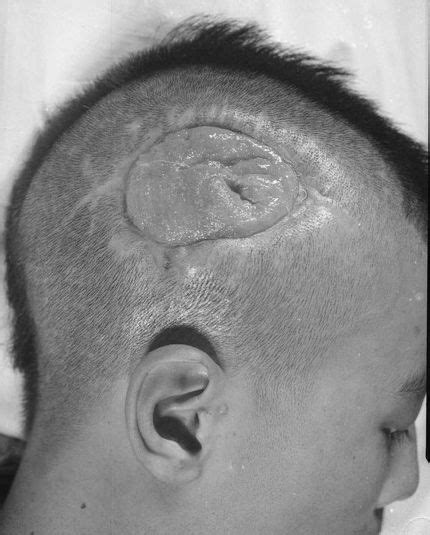 Patient With Gunshot Wound To The Cranial Cavity And Cerebral Fungus In
