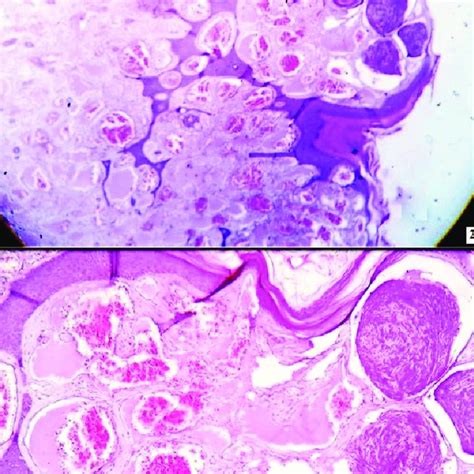 A Histopathology Showing Epidermal Hyperkeratosis Papillomatosis