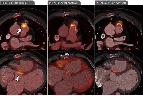 18f Fdg Petct Angiography In The Diagnosis Of Infective Endocarditis