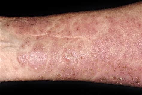 Bullous Pemphigoid Nhs