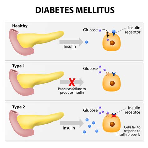 Diabetes: the tale of two types » HealthStyle