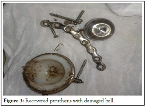 Prosthetic Hip Associated Cobalt Toxicity And Refractory Anaemia