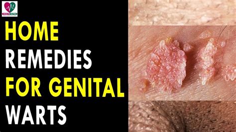 home remedies for genital warts health sutra best health tips youtube