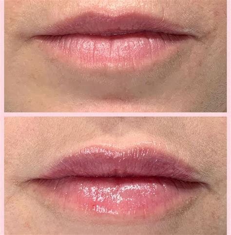 Subtle Lip Enhancement Beauty Lounge Med Spa Lip Enhancement