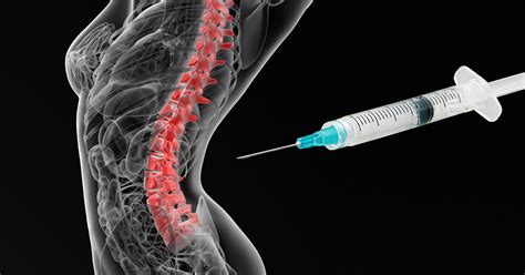 Lumbar Facet Injections For Back And Leg Pain New Iberia La